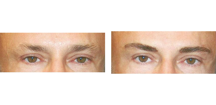 Before and After - Male Eyebrows