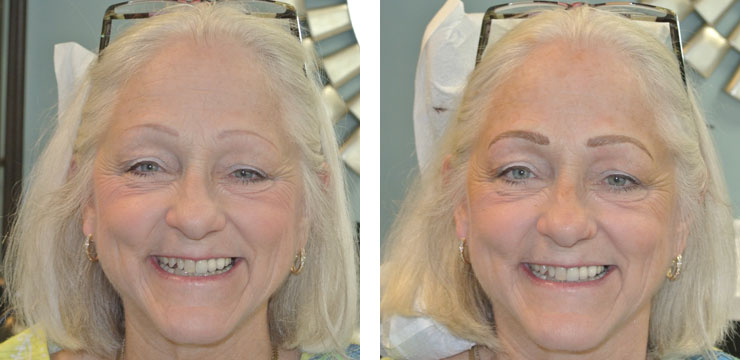 Before and After - Eyebrow Microblading