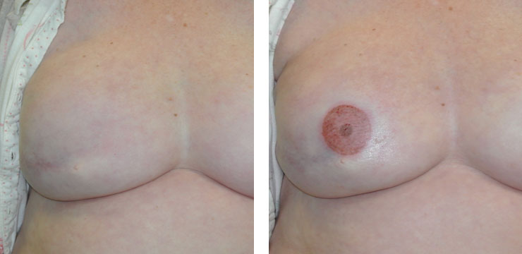 Before and After - Nipple Reconstruction