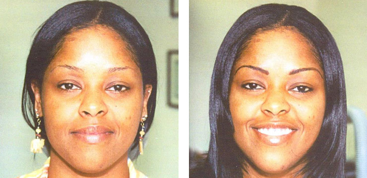 Before and After - Eyebrows
